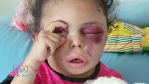 Buthaina, 6 ans, la seule survivante du massacre de Attan à Sanaa2